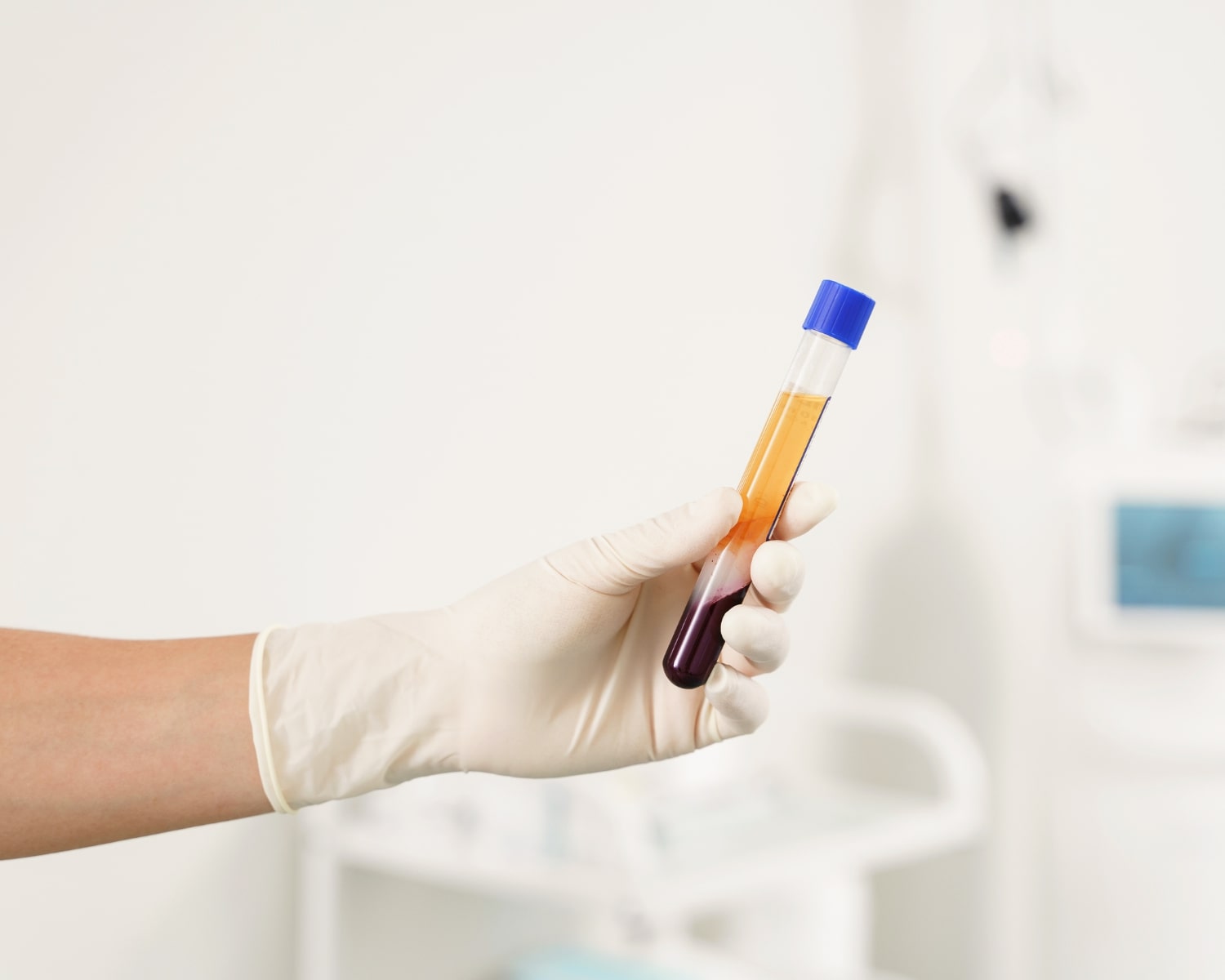Platelet Rich Plasma