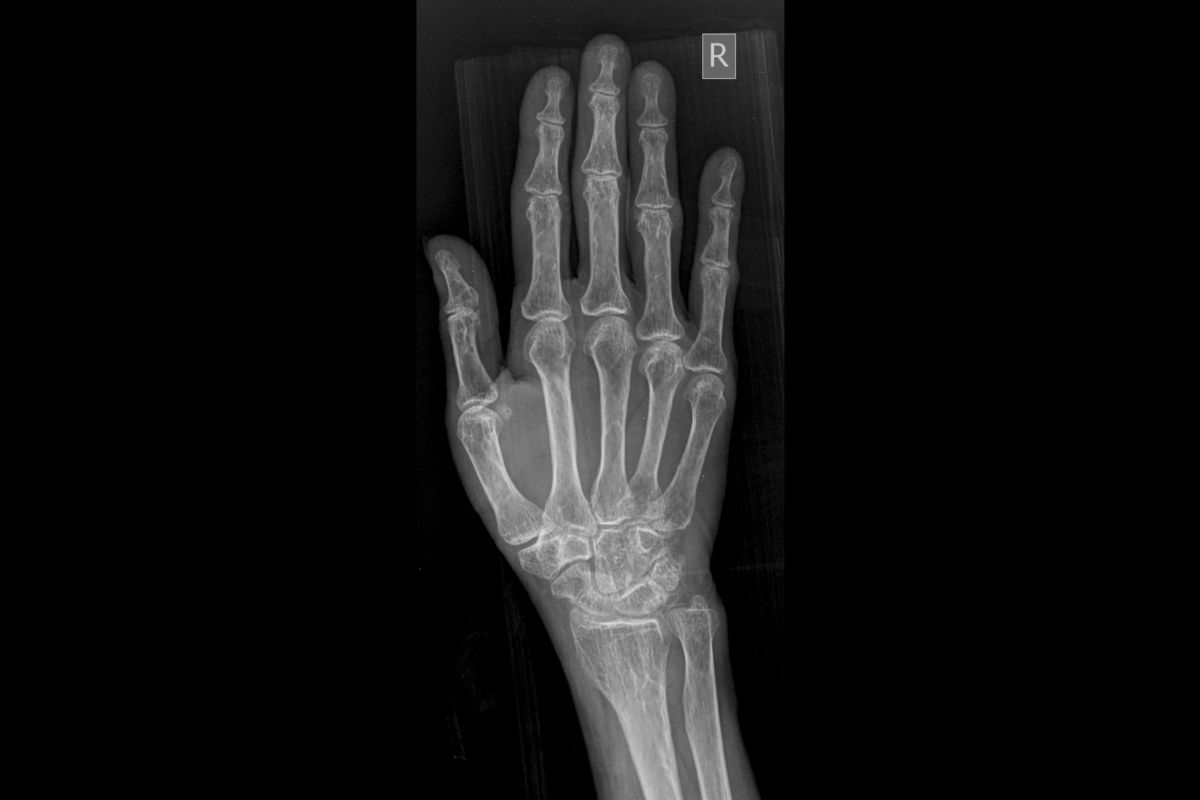Hand X-ray showing joints and bones treated with stem cell therapy at Stem Cell Carolina Charlotte NC